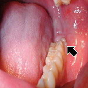 阻生齒牙冠周圍炎疼痛