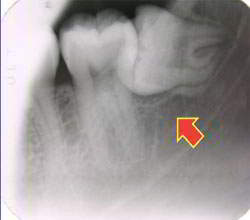 X光片顯示左下顎智齒為阻生齒