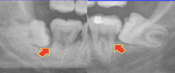 阻生齒及鄰牙牙周病