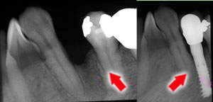 單顆缺牙植牙前及完成X光