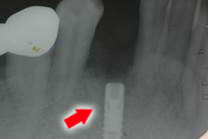 植入人工牙根後的X光片
