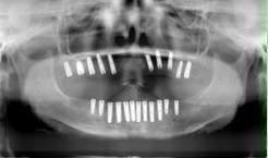 植牙後牙套未完成X光